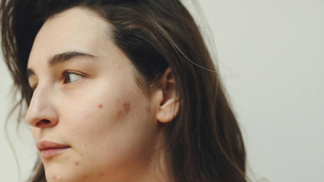 Een vrouw met donker haar, een bleke huid en lichte acne kijkt opzij met een ernstige uitdrukking op haar gezicht. 