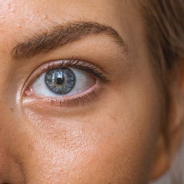 Acne littekens voorkomen en verminderen