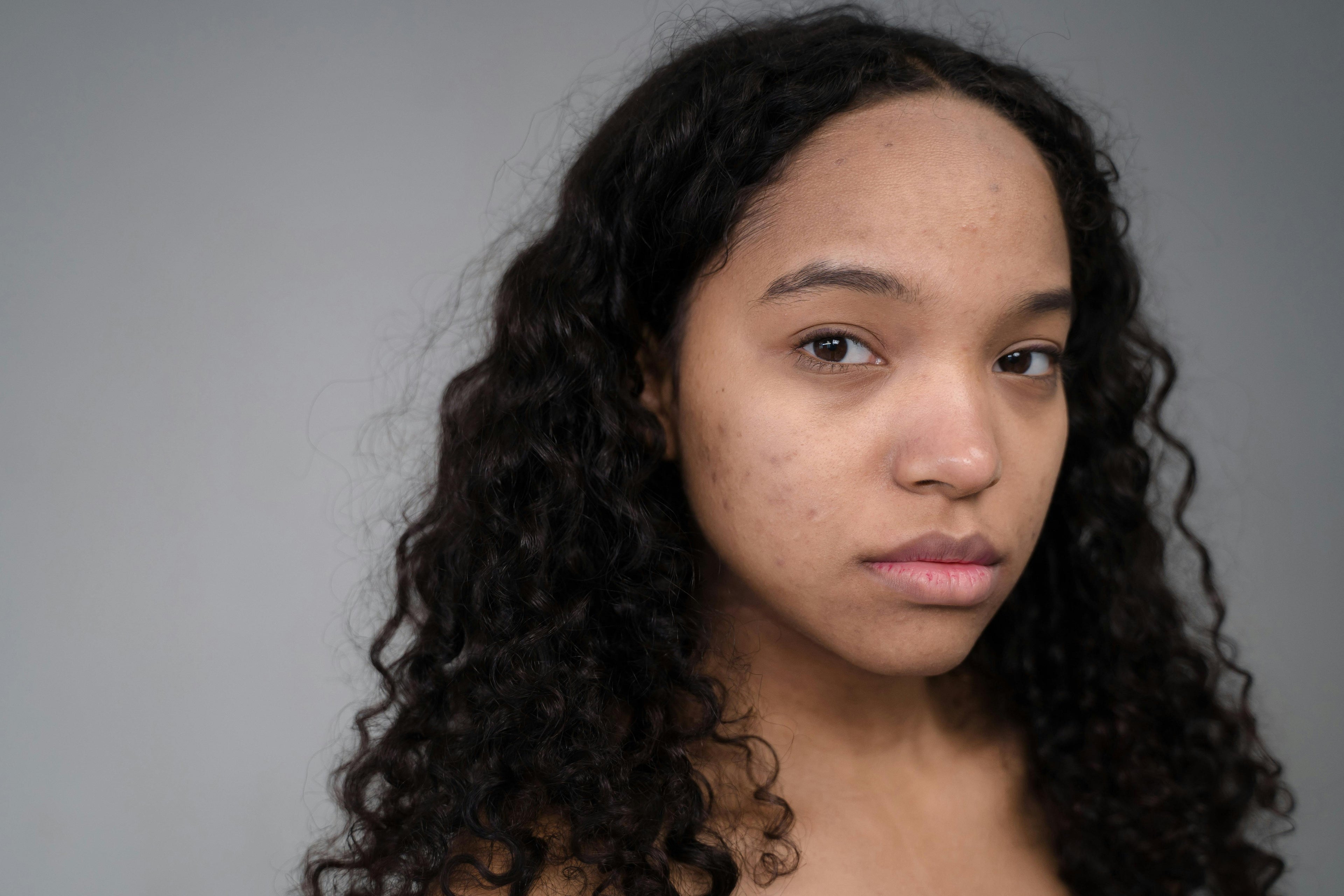 Rosacea of acne: hoe herken je het verschil?