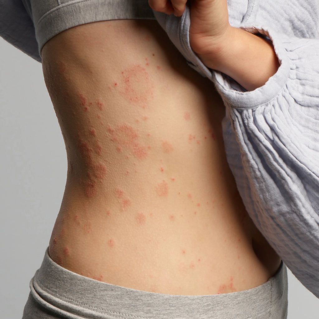 Een vrouw laat haar eczeem op haar buik zien