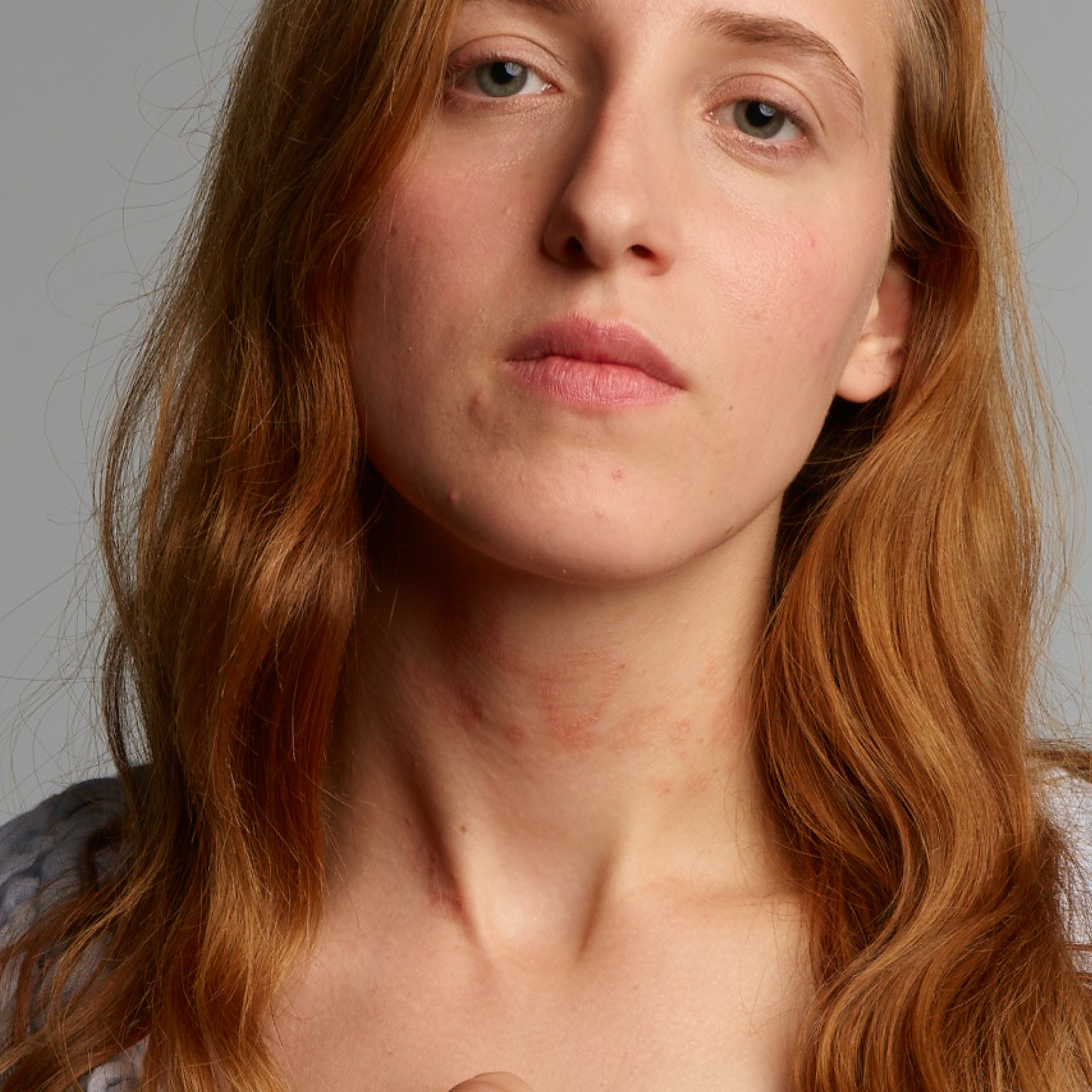 Een vrouw met een gevoelige huid, zichtbare rode plekken in de nek